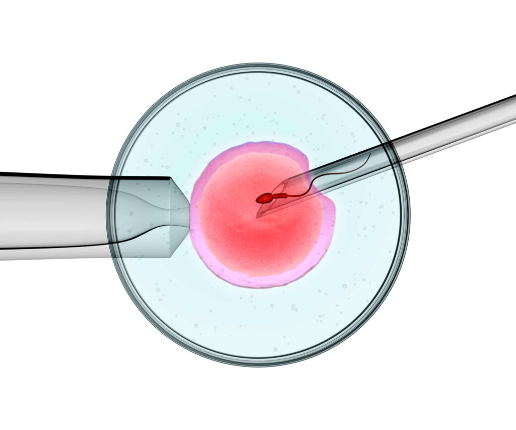 Ellsworth Plastic Surgery What is Intracytoplasmic Sperm Injection (ICSI)?