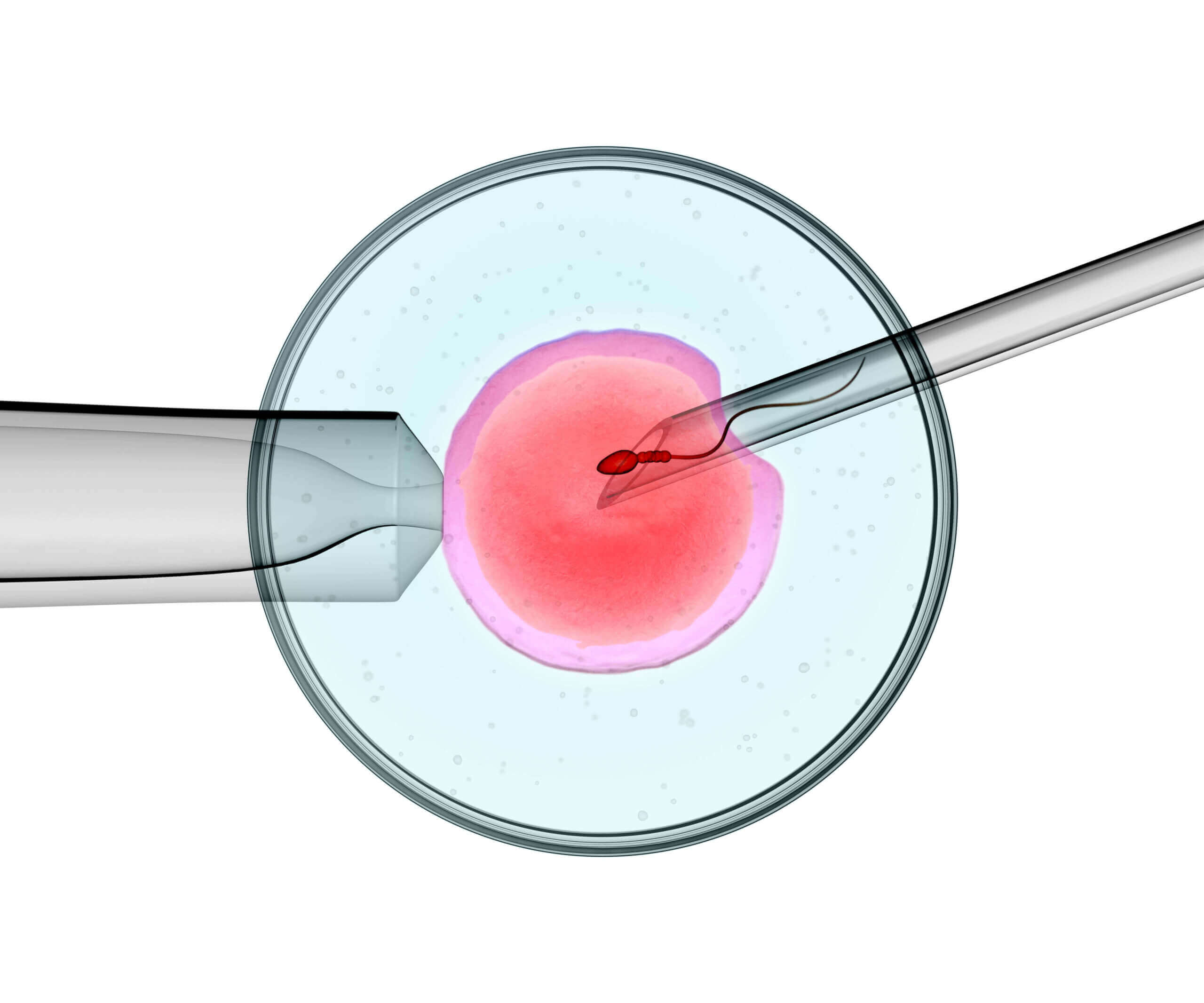 What is Intracytoplasmic Sperm Injection (ICSI)? - Image