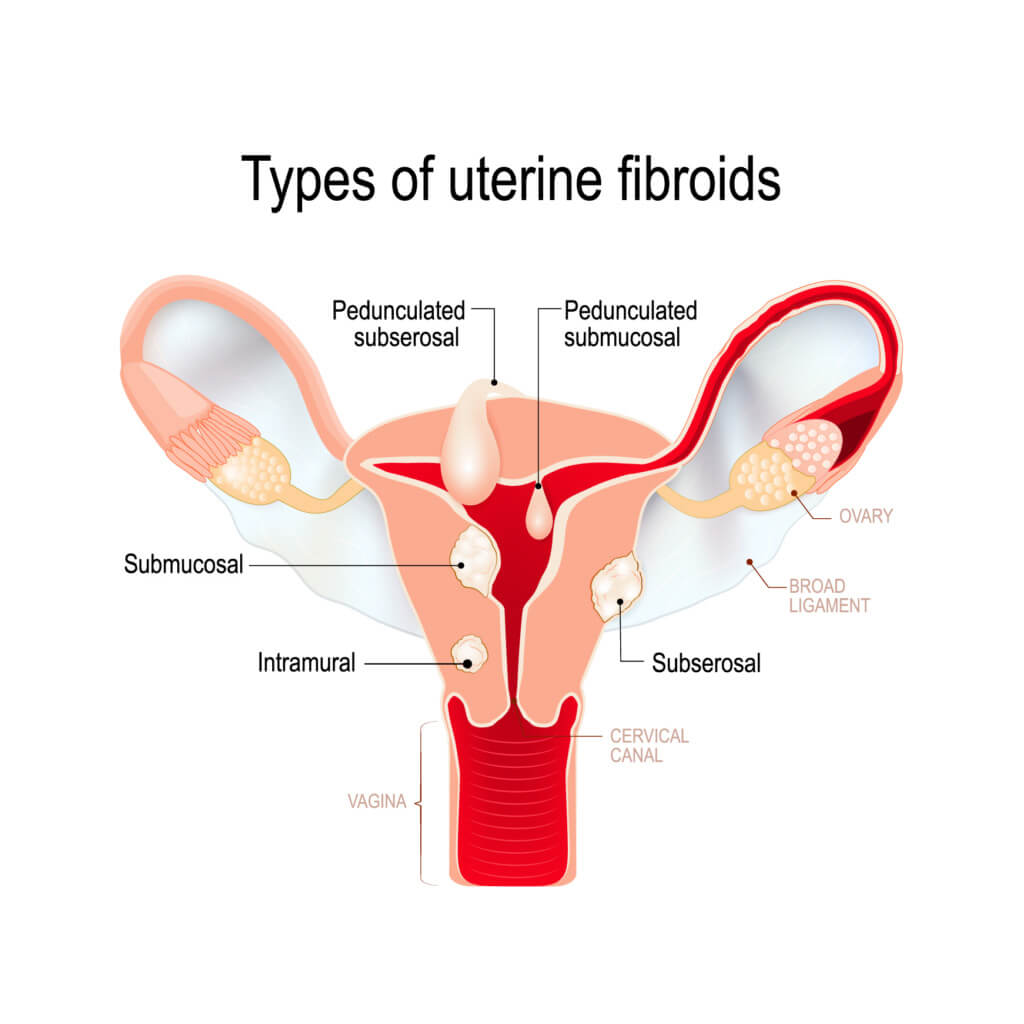 uterine fibroids diagram